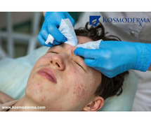 Best Pimple Treatment Clinic in Delhi | Top Dermatologist for Acne at Kosmoderma