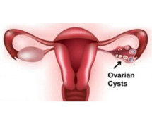 Safe & Advanced Ovarian Cyst Care in Jaipur