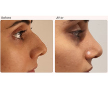 Nose Reshaping Surgery in Delhi