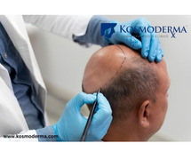 Hair Transplant Cost in Delhi | Affordable & Expert Hair Restoration at Kosmoderma