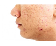 Acne Scar Treatment in Delhi - Transform Your Skin