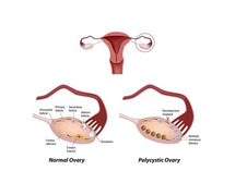 Best Age to Get Pregnant with PCOS