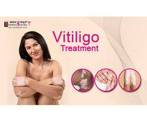 Best Vitiligo Treatment in Bangalore at Dermaqure