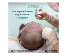 Hair Regrowth Made Easy with FUE Transplant!