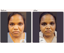 What Is Augmentation Rhinoplasty? All You Need to Know