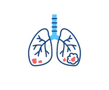 Best Lung Cancer Treatment Hospitals in Bangalore