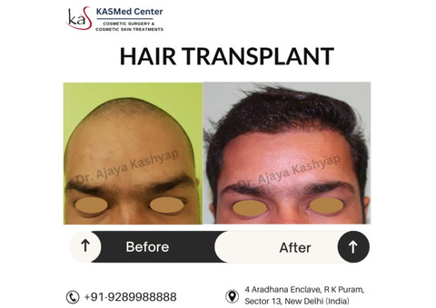 Restore Your Hair with Expert Hair Transplant Surgery in Delhi!