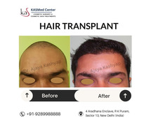 Restore Your Hair with Expert Hair Transplant Surgery in Delhi!