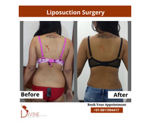 Transform Your Body with Liposuction in Delhi - Dr. Amit Gupta