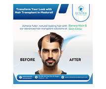 hair transplant in madurai - Renew Hair and Skin Care