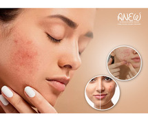 Advanced Acne Treatment in Goa - Anew Cosmetic Clinic