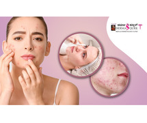 Best Acne Treatment in Bangalore – Dermaqure