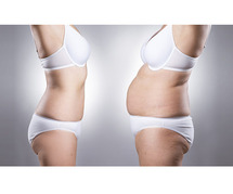 Procedure of Tummy Tuck Surgery in Delhi