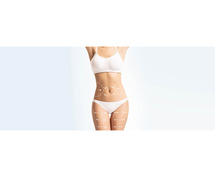 Procedure of Liposuction Surgery in Delhi