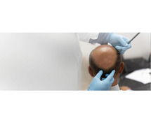 BIO FUE Hair Transplant in Mumbai