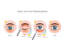 Procedure of Blepharoplasty Surgery in Delhi