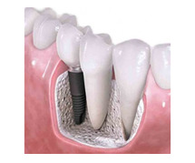 Top Quality Dental Implants in Noida