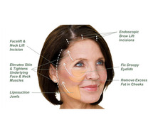 Procedure of Facelift in Delhi