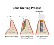 Looking for the Best Bone Graft Manufacturer in India?