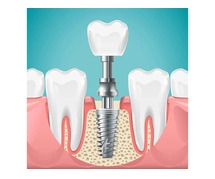 Cost of One Dental Implant: Price Breakdown and Key Factors