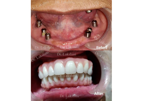 Dental Implants in Bangalore - Perfect Smile Super speciality