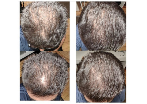 Best Hair Transplant Clinic Near You – Affordable & Effective