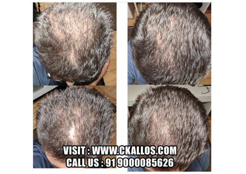 Best Hair Transplant Clinic Near You – Affordable & Effective