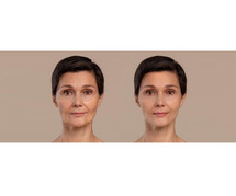 What to Expect When Getting a Facelift?