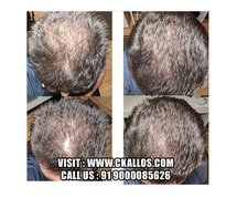 Best Hair Transplant Clinic Near You – Affordable & Effective