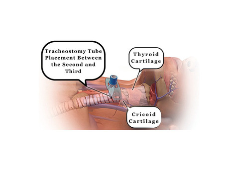 Tracheostomy Tube Change at Home in Delhi NCR | Expert Nursing Care – CareOxy