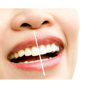 Teeth Whitening at Discounted Rates – Limited Time in Ahmedabad!