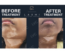 Best Doctor & Best Homeopathic Vitiligo Treatment and Packs.