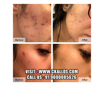 Clear Acne Fast – Proven Treatment for Pimples & Breakouts in Hyderabad