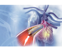 Angioplasty Hospitals in Raipur
