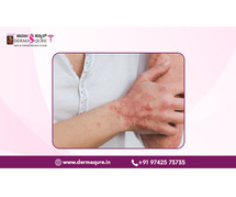 Effective Lichen Planus Treatment in Bangalore