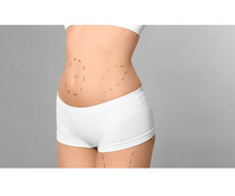 High-Definition Liposuction: Sculpt Your Body with Precision