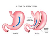 Take the First Step with Gastric Sleeve Surgery in Ahmedabad