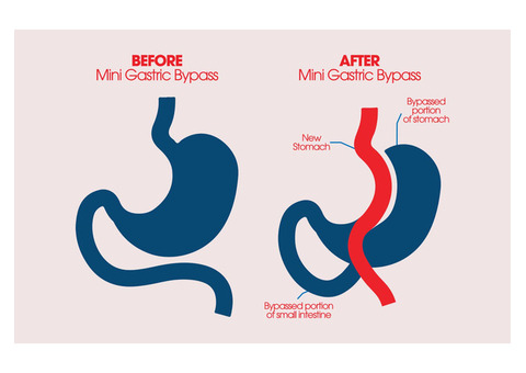 Reshape Your Future with Mini Gastric Bypass Surgery in Ahmedabad