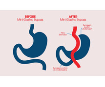 Reshape Your Future with Mini Gastric Bypass Surgery in Ahmedabad