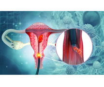 Say Goodbye to Pelvic Pain with Expert Endometriosis Treatment in Ahmedabad