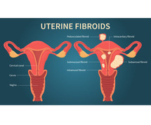 Understanding Uterine Fibroids: Risks, Causes & Effective Treatment Options in Ahmedabad