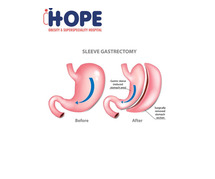 Smooth Recovery After Gastric Sleeve Surgery