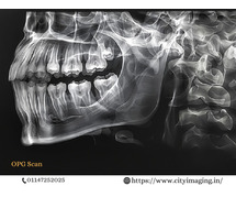 OPG X-Ray Cost Near You Affordable & Quick Scan