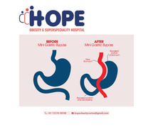 Transform Your Health with Mini Gastric Bypass Surgery