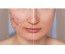 Acne Scar Treatment