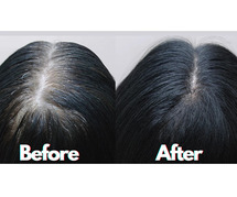 Grey Hair Treatment
