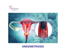 Understanding the Signs of Endometriosis: Early Awareness Matters