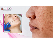 Best Open Pores Treatment in Bangalore