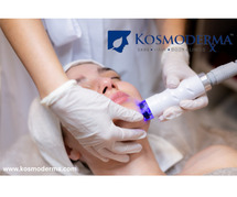Laser Therapy and Resurfacing Treatment in Bangalore - Kosmoderma Skin and Hair Clinic