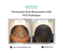 Permanent Hair Restoration with FUE Technique